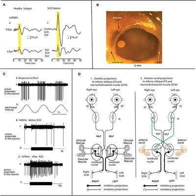 A Simple Specific Functional Test for SCD: VEMPs to High Frequency (4,000Hz) Stimuli—Their Origin and Explanation